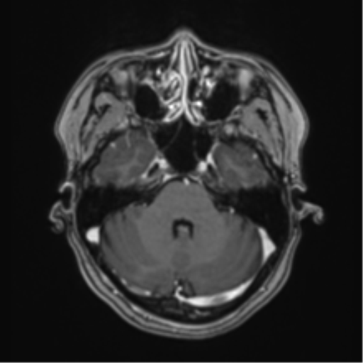 Anaplastic astroblastoma (Radiopaedia 55666-62194 Axial T1 C+ 20).png