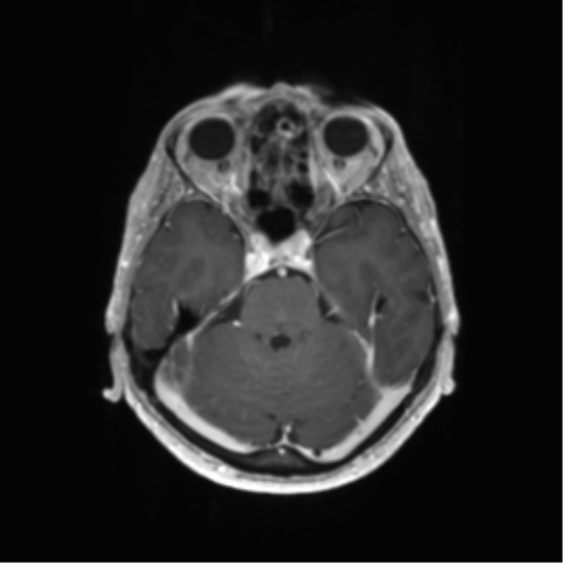 File:Anaplastic astrocytoma (Radiopaedia 86943-103160 Axial T1 C+ 3).png