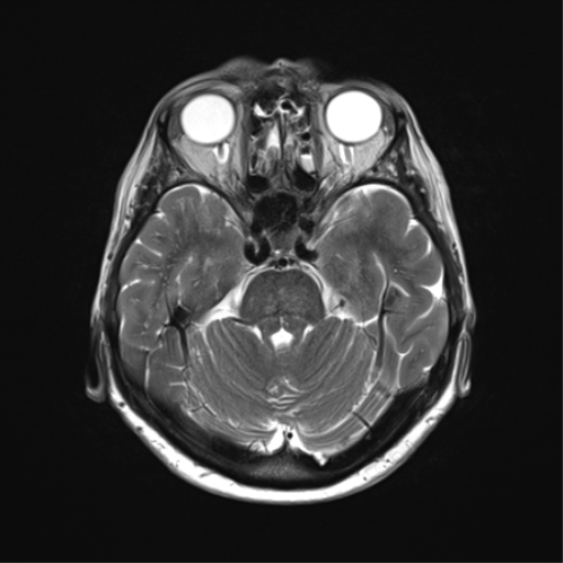 File:Anaplastic astrocytoma (Radiopaedia 86943-103160 Axial T2 14).png