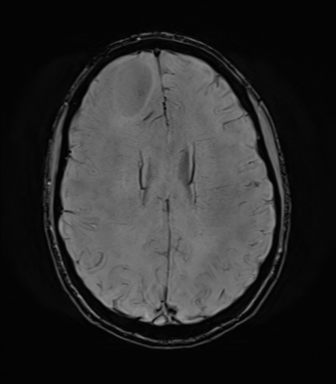 File:Anaplastic astrocytoma IDH mutant (Radiopaedia 50046-55341 Axial SWI 58).png