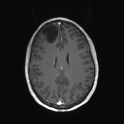 File:Anaplastic astrocytoma IDH mutant (Radiopaedia 50046-55341 Axial T1 C+ 33).png