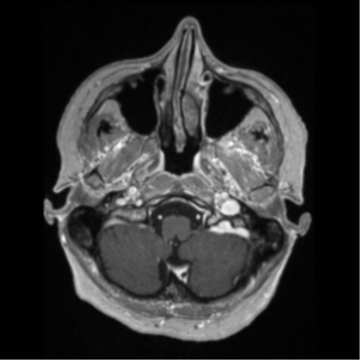 File:Anaplastic astrocytoma IDH wild-type (pseudoprogression) (Radiopaedia 42209-45276 Axial T1 C+ 26).png