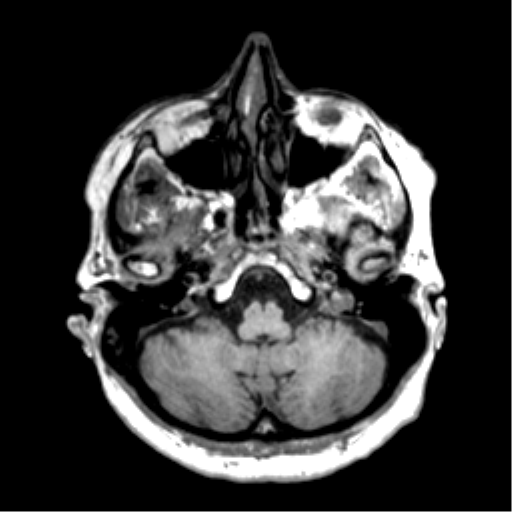 Anaplastic astrocytoma IDH wild-type (pseudoprogression) (Radiopaedia 42209-45277 Axial T1 24).png