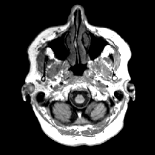 Anaplastic astrocytoma IDH wild-type (pseudoprogression) (Radiopaedia 42209-45277 Axial T1 9).png