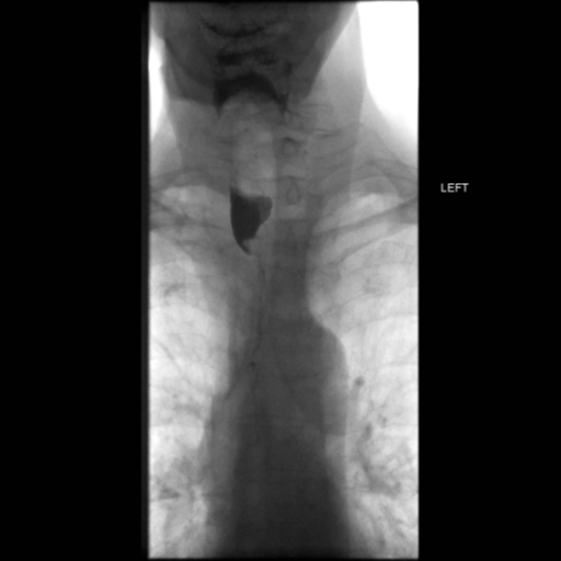 File:Anastomotic stricture post Ivor Lewis esophagectomy (Radiopaedia 47937-52715 Frontal 7).png