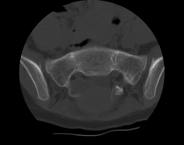 Aneurysmal bone cyst - sacrum (Radiopaedia 65190-74195 Axial bone window 19).jpg