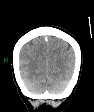 File:Aneurysmal subarachnoid hemorrhage with intra-axial extension (Radiopaedia 84371-99699 Coronal non-contrast 17).jpg