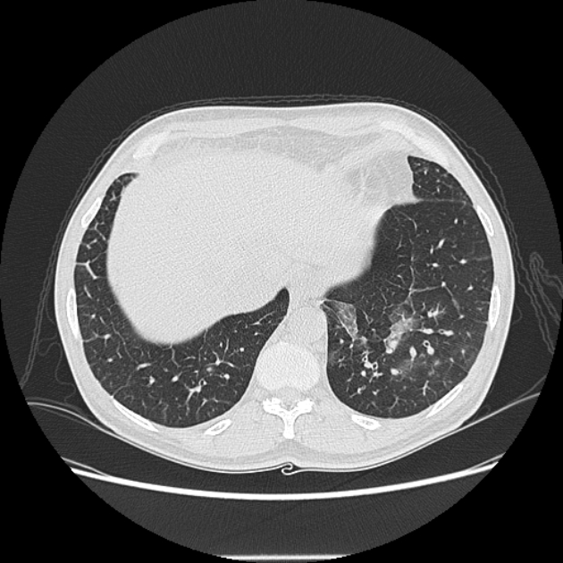 Angioinvasive aspergellosis (Radiopaedia 66995-76315 Axial lung window 43).jpg