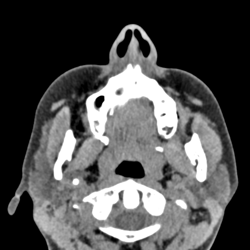Angular dermoid cyst (Radiopaedia 88967-105790 Axial non-contrast 6).jpg