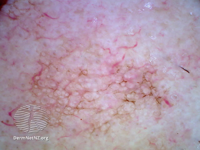 File:Angulated lines seen on dermoscopy of actinic keratosis (DermNet NZ angulated-lines-in-actinic-keratosis-dermoscopy).jpg