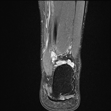 Ankle syndesmotic injury (Radiopaedia 69066-78837 Coronal PD fat sat 17).jpg