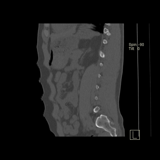 File:Ankylosing spondylitis (Radiopaedia 52728-58645 Sagittal bone window 1).jpg