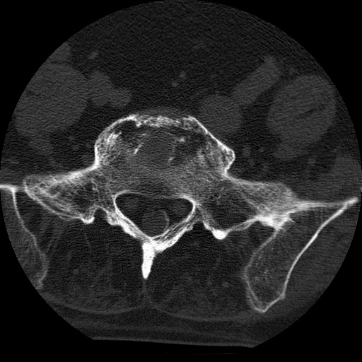 File:Ankylosing spondylitis complicated by fracture-dislocation (Radiopaedia 33583-34674 Axial non-contrast 146).jpg