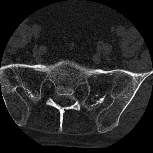 Ankylosing spondylitis complicated by fracture-dislocation (Radiopaedia 33583-34674 Axial non-contrast 161).jpg
