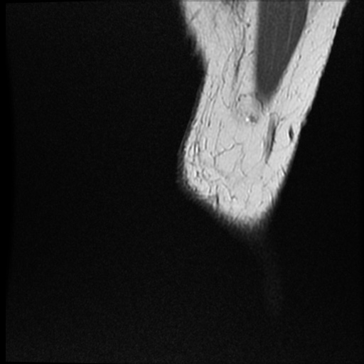 Anomalous insertion of the medial meniscus (Radiopaedia 77559-89721 Sagittal PD 54).jpg