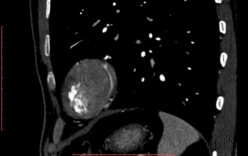 Anomalous left coronary artery from the pulmonary artery (ALCAPA) (Radiopaedia 70148-80181 C 242).jpg