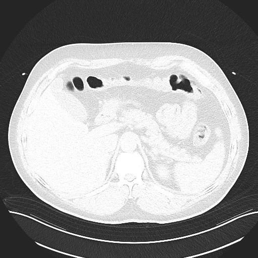File:Anomalous origin of the left coronary artery with malignant course (Radiopaedia 77842-90126 Axial lung window 35).jpeg