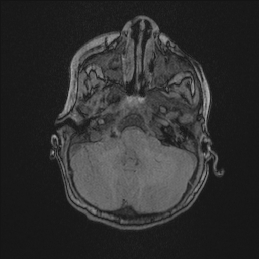 File:Anoxic brain injury (Radiopaedia 79165-92139 Axial MRA 46).jpg