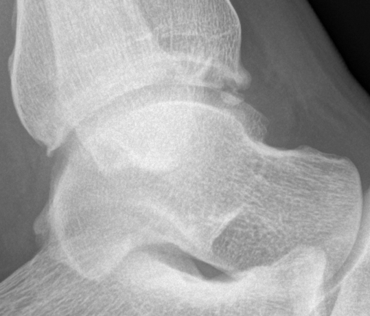 File:Anterior ankle impingement (Radiopaedia 18510).jpg