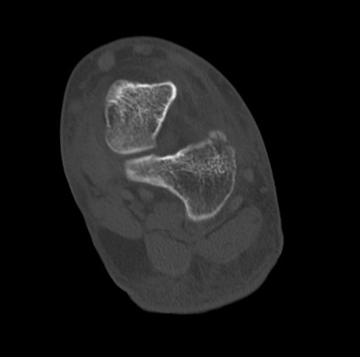 Anterior calcaneal process fracture (Radiopaedia 47384-51989 Coronal bone window 55).png