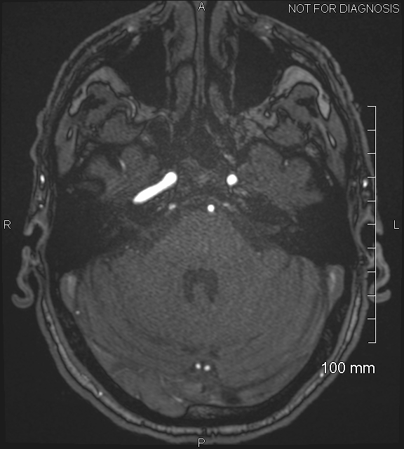 Anterior cerebral artery aneurysm (Radiopaedia 80683-94127 Axial MRA 56).jpg