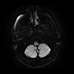 Anterior cerebral artery infarction (Radiopaedia 46794-51323 Axial DWI 5).jpg