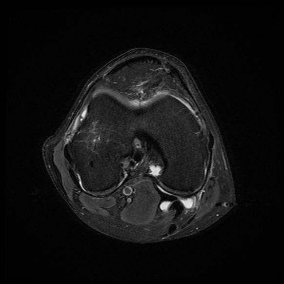 File:Anterior cruciate ligament graft tear and bucket-handle tear of medial meniscus (Radiopaedia 75867-87254 Axial PD fat sat 14).jpg