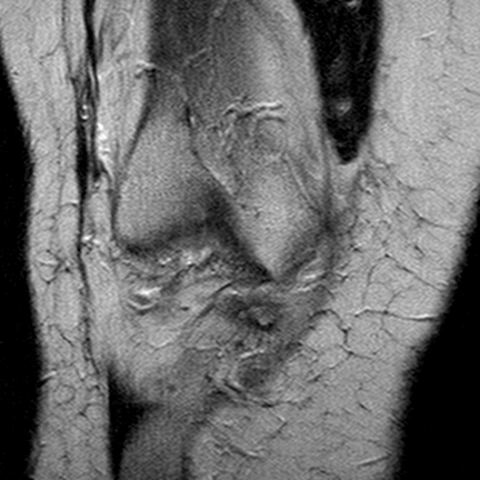 File:Anterior cruciate ligament mucoid degeneration (Radiopaedia 60853-68633 Coronal T2 10).jpg