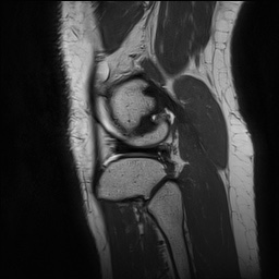 Anterior cruciate ligament rupture and posteromedial corner injury (Radiopaedia 67338-76723 Sagittal PD 140).jpg