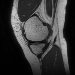 File:Anterior cruciate ligament rupture and posteromedial corner injury (Radiopaedia 67338-76723 Sagittal PD 41).jpg