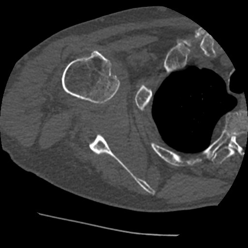 Anterior glenohumeral dislocation with Hill-Sachs lesion (Radiopaedia 62877-71249 Axial bone window 49).jpg