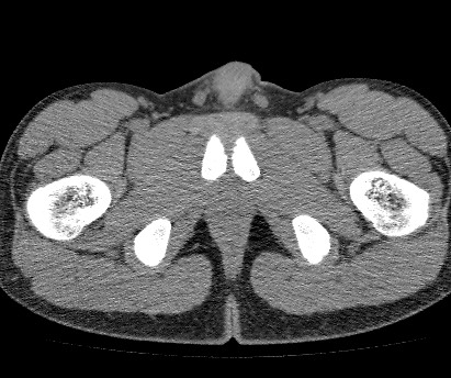 Anterior inferior iliac spine avulsion fracture (Radiopaedia 81312-94999 Axial non-contrast 67).jpg