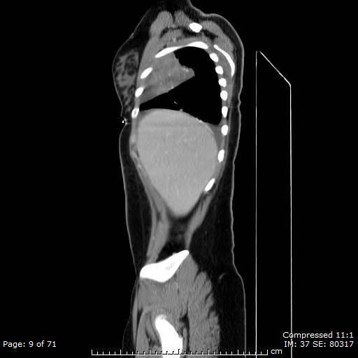 File:Anterior mediastinal B cell Lymphoma (Radiopaedia 50677-56114 C 5).jpg