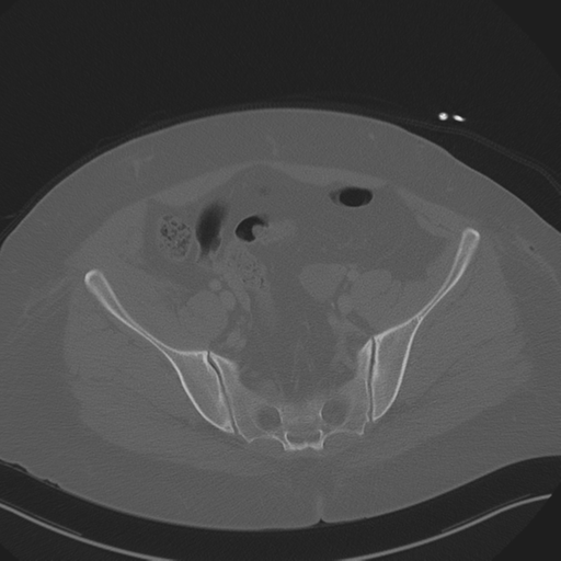 Anterior superior iliac spine avulsion fracture (Radiopaedia 44541-48244 Axial bone window 79).png