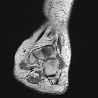 File:Anterior talofibular ligament injury - rupture with soft-tissue impingement (Radiopaedia 38765-40928 Coronal PD 25).jpg