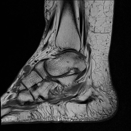 File:Anterior talofibular ligament injury - rupture with soft-tissue impingement (Radiopaedia 38765-40928 Sagittal PD 7).jpg