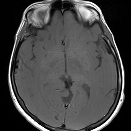 File:Anterior temporal encephalocele (Radiopaedia 82624-96808 Axial T1 18).jpg