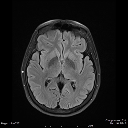 File:Anterior temporal lobe perivascular space (Radiopaedia 88283-104914 Axial FLAIR 16).jpg