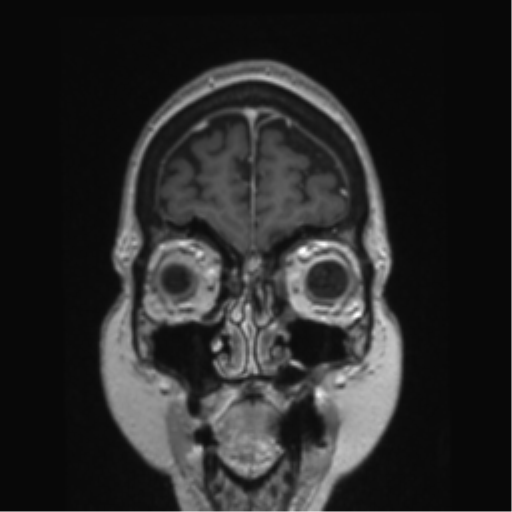 Anterior temporal pole cysts (Radiopaedia 46629-51102 Coronal T1 C+ 151).png