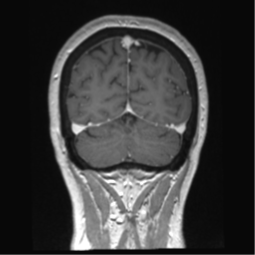 Anterior temporal pole cysts (Radiopaedia 46629-51102 Coronal T1 C+ 37).png