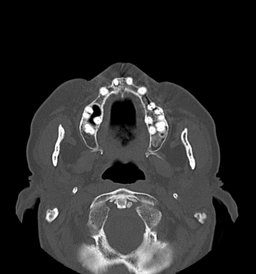 Anterior temporomandibular joint dislocation (Radiopaedia 59430-66784 Axial non-contrast 25).jpg