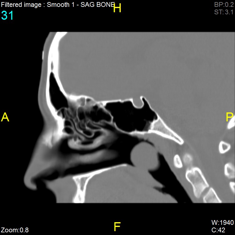 Antrochoanal polyp (Radiopaedia 65101-74094 Sagittal bone window 31).jpg