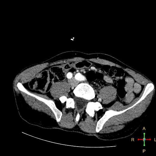 File:Aortic aneurysm and penetrating ulcer (Radiopaedia 23590-23704 A 39).jpg