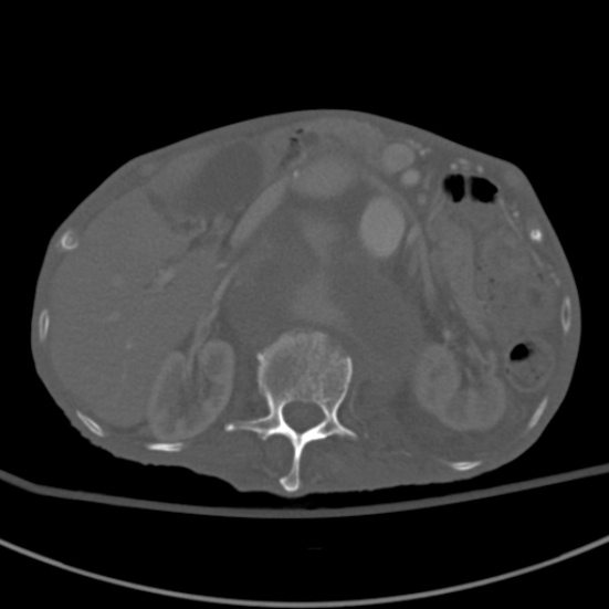 Aortic aneurysm with spinal destruction (Radiopaedia 42301-45410 Axial bone window 32).jpg