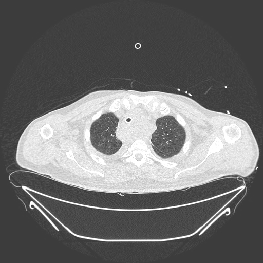 Aortic arch aneurysm (Radiopaedia 84109-99365 Axial lung window 67).jpg