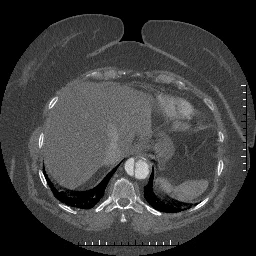 File:Aortic dissection- Stanford A (Radiopaedia 35729-37268 B 19).jpg