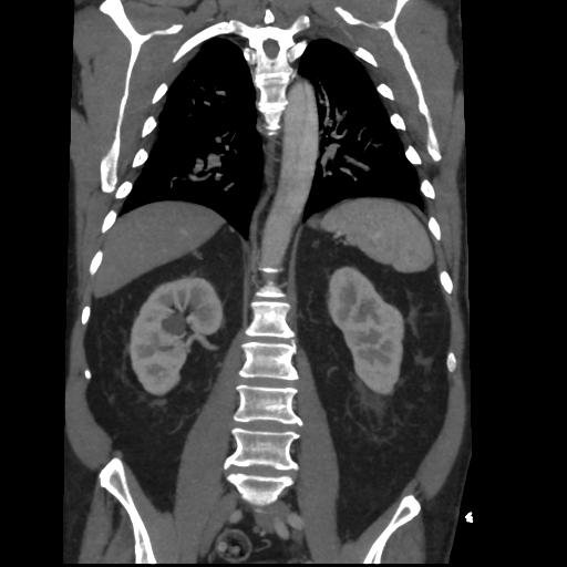 File:Aortic dissection- Stanford A (Radiopaedia 37759-39664 Coronal C+ delayed 35).png