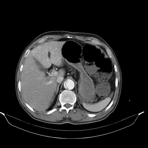 Aortic dissection- Stanford type A (Radiopaedia 22085-22085 A 39).jpg