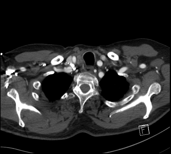 Aortic dissection (CTPA) (Radiopaedia 75506-86750 A 9).jpg