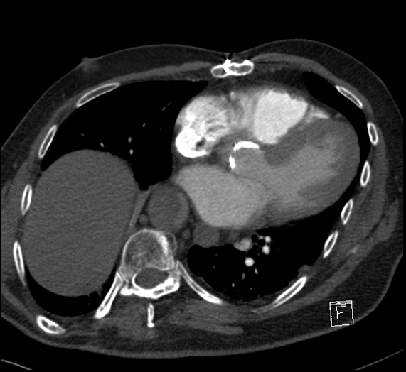 File:Aortic dissection (CTPA) (Radiopaedia 75506-86751 Axial C+ CTPA 89).jpg